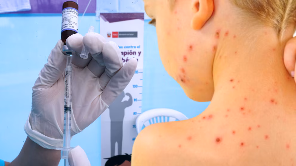 EE.UU. en alerta: ¿Por qué reaparecen enfermedades prevenibles como sarampión, tosferina y otras enfermedades?
