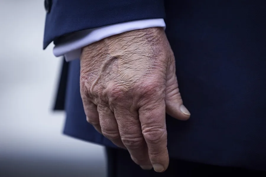 Diagnostican a Trump con insuficiencia venosa: ¿Qué significa?
