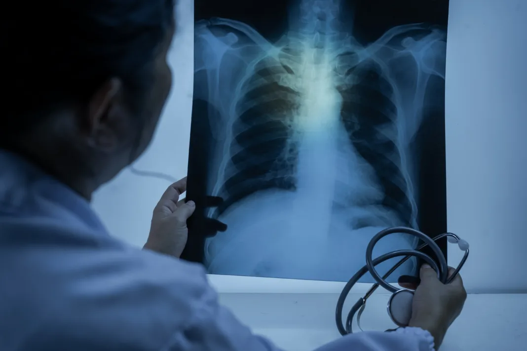 ¿Qué es la peste neumónica y por qué preocupa en EE.UU.?